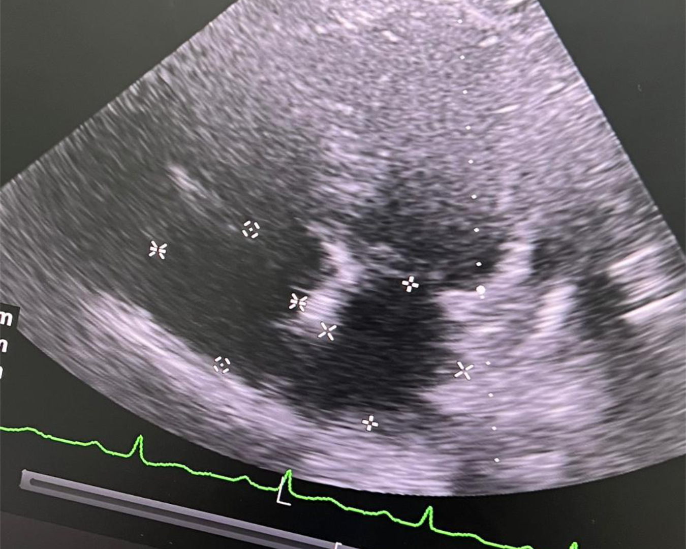 Ecocardiograma trastorácico (ultrasonido cardiaco)