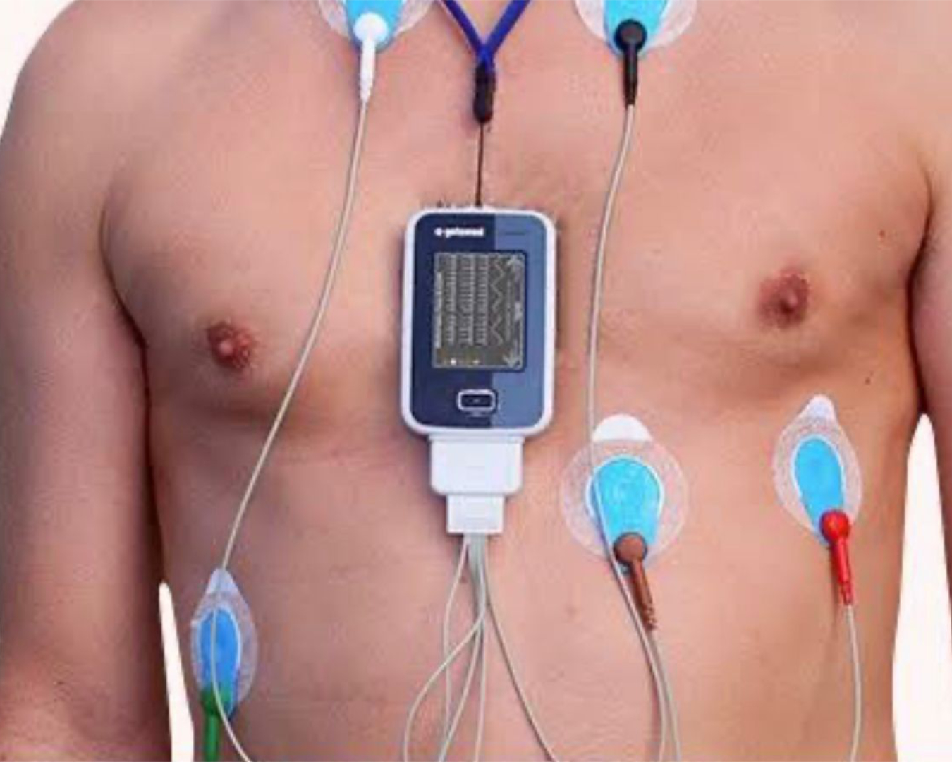 Holter (monitoreo ECG de 24h)